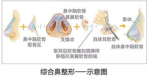 鼻子整形有几种方法？哪里隆鼻比较好？徐州优俪智美怎么样？