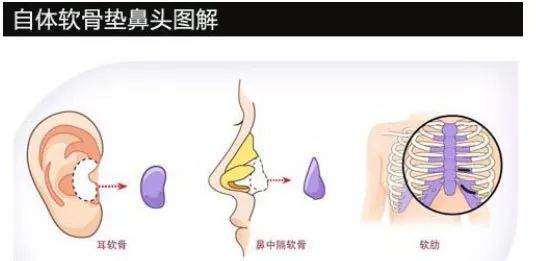 鼻子整形有几种方法？哪里隆鼻比较好？徐州优俪智美怎么样？